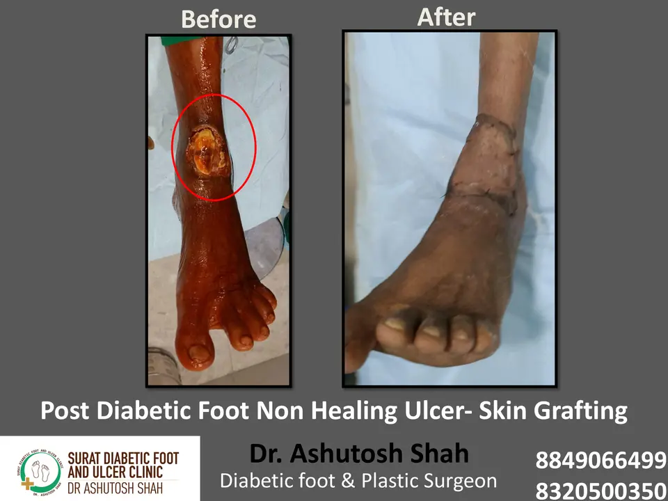 Diabetic Foot  PPT 3 checked by sir.pptx-14.webp